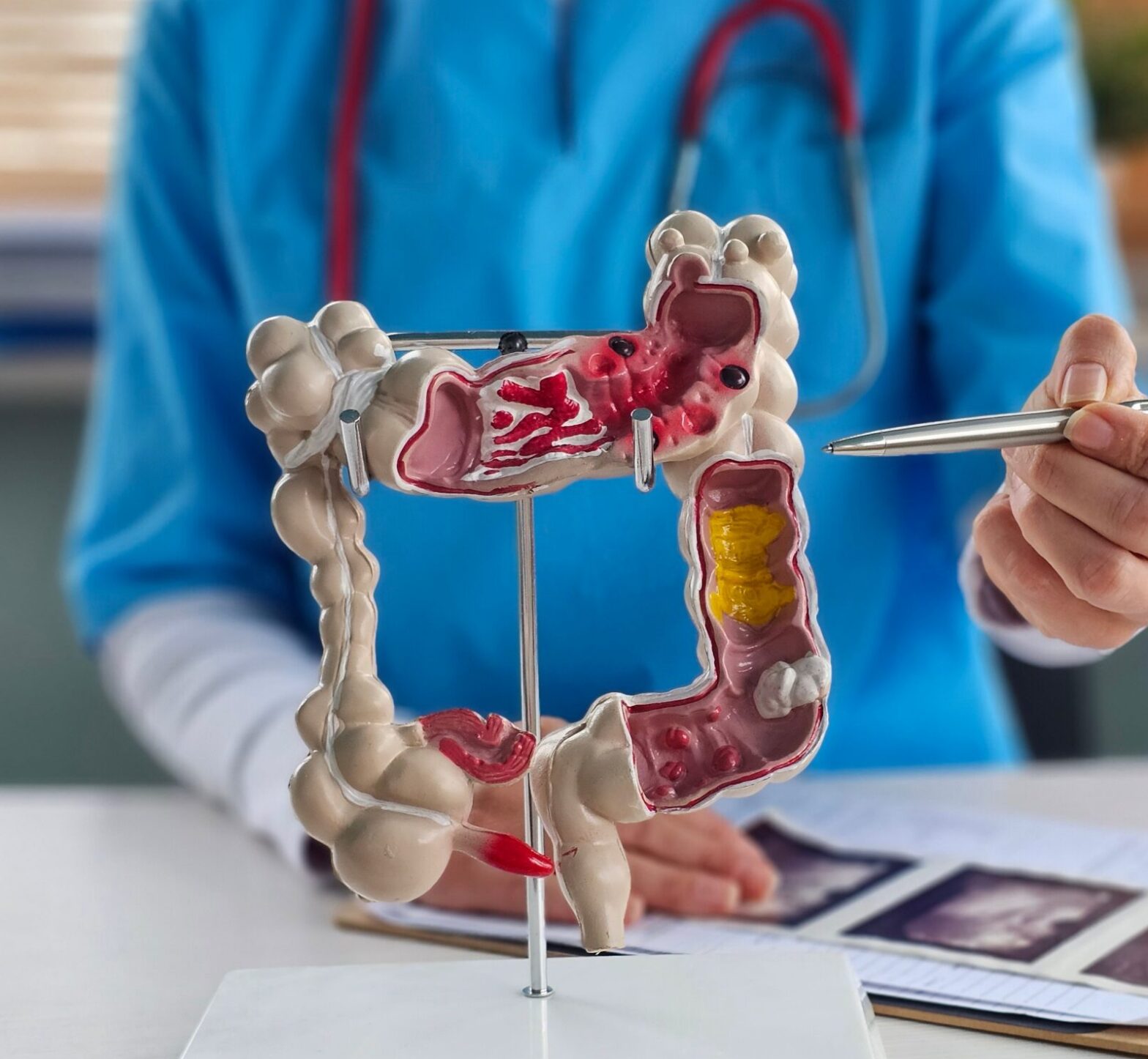 Colon diseases and colorectal cancer image with doctor